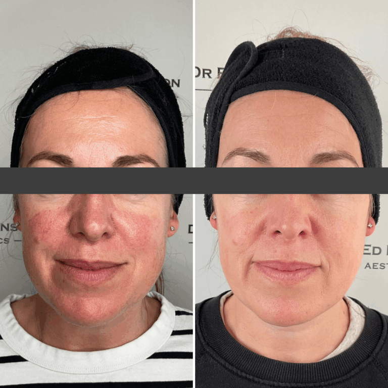 BBLRosacea