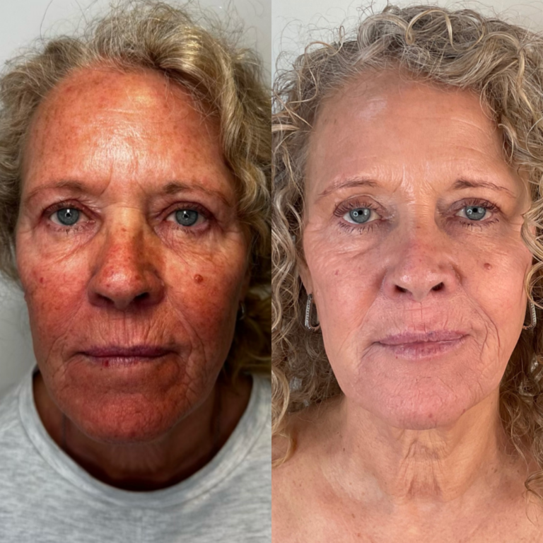 DS Laser before and after